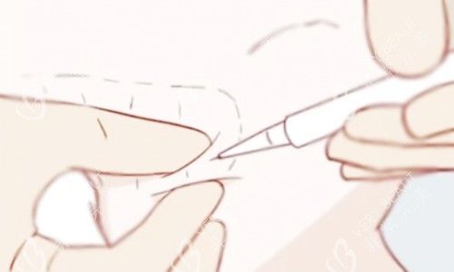 溶脂针