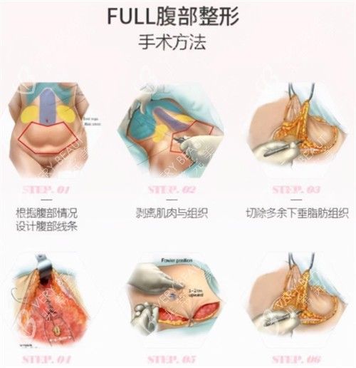 腹壁成形術(shù)手術(shù)過程圖解