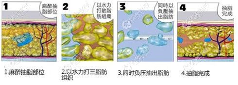 大腿粗52厘米去吸脂1000ml能瘦多少