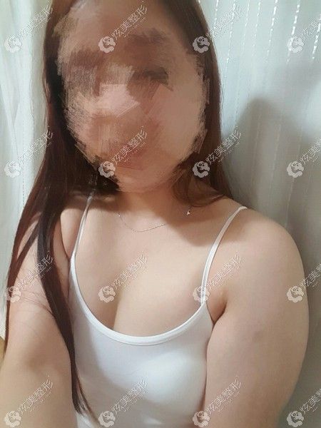 聊聊在韩国芙莱思做手臂和副乳抽脂的恢复过程,想去副乳不一定得切除