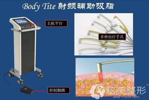 宝丽太属于溶脂还是抽脂?和水动力吸脂的区别有哪些