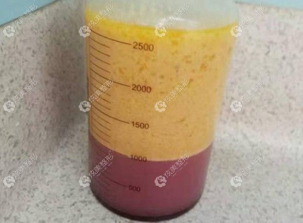 去贵阳美贝尔抽2000ml脂肪,哪个医生做的好