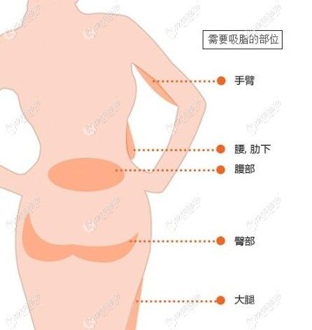 宁波艺星整形做全身吸脂的价格谁有?做一次水动力大腿抽脂得多钱