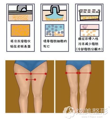 大腿做完酷塑冷冻溶脂很遭罪 一周后特别酸痒肉疼正常吗