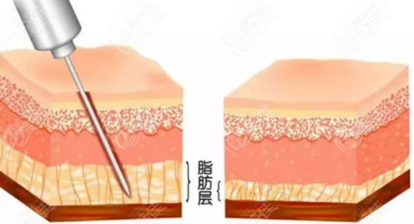 吸脂