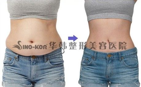 腹部吸脂效果图
