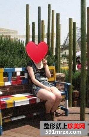 大腿部吸脂减肥效果前后对比图 大腿部吸脂手术恢复全过程
