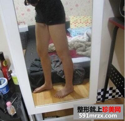 大腿部吸脂减肥效果前后对比图 大腿部吸脂手术恢复全过程