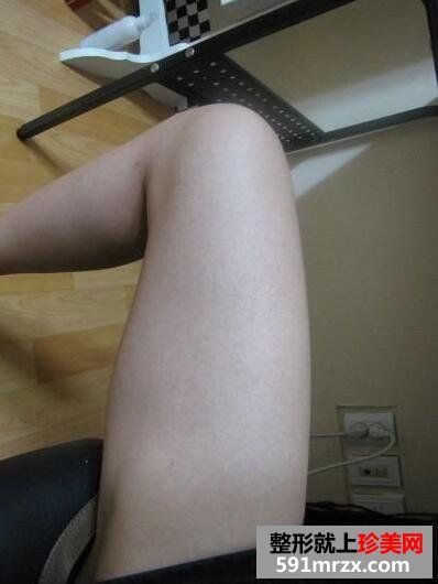 大腿部吸脂减肥效果前后对比图 大腿部吸脂手术恢复全过程