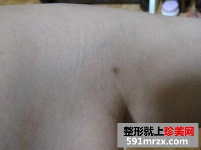 大腿部吸脂减肥效果前后对比图 大腿部吸脂手术恢复全过程
