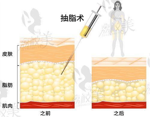 广州张涛医生吸脂