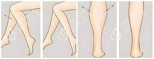 腿部吸脂手术前后对比动画图