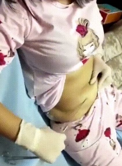 吸脂需要缝线吗_吸脂要做手术吗_吸脂多少钱需要