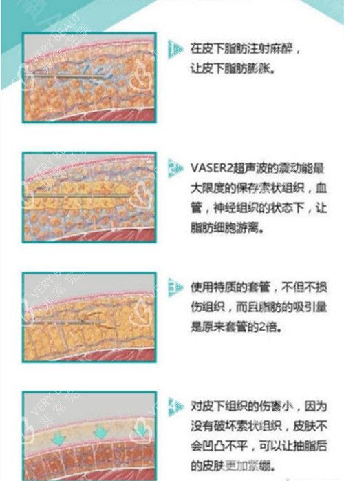 威塑手术机器与手术方式演示动画图