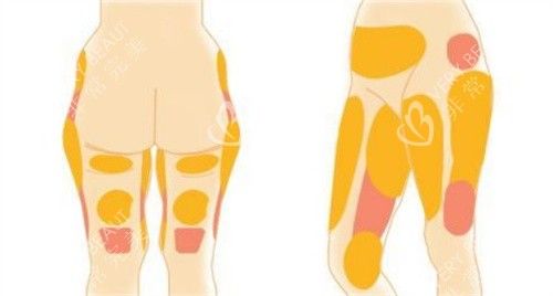 腿部吸脂部位