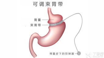 缩胃手术能不能瘦身,需要多少钱?