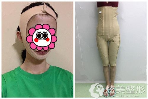 吸脂术后带头套或者塑身衣