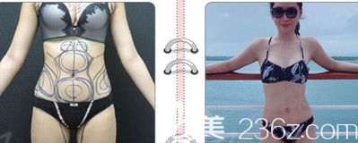 水动力吸脂腰腹案例一