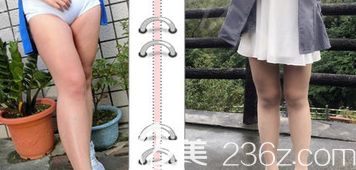 水动力吸脂腿部案例二：