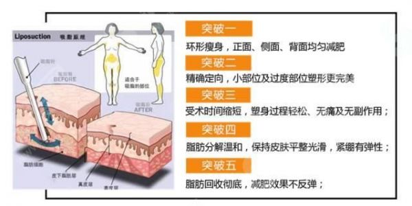 水动力吸脂价格一览表数据公布&水动力吸脂原理/优缺点/流程在线查询更方便&附带了真人整形的案例果分享！