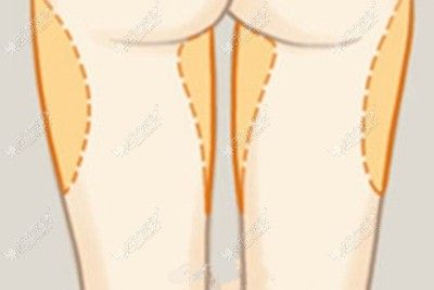 大腿吸脂的部位