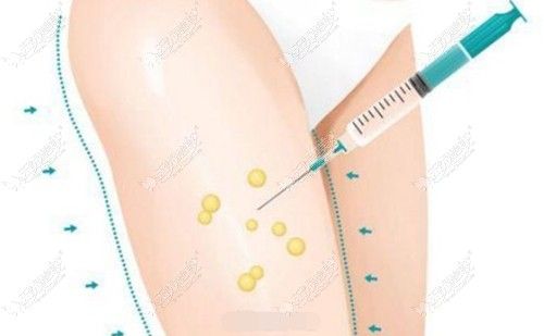 大腿吸脂手术