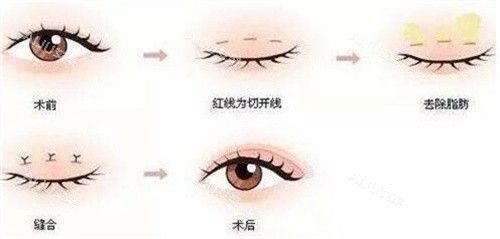 </p><p>祛眼袋：2190元-5390元左右</p><p>内眼角：3598元-3968元左右</p><p>外眼角：3480元-3898元左右</p><p>开眼角：8280元-11159元左右</p><p>眼修复：5760元-9468元左右</p><p><img src=