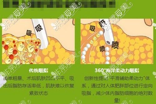 吸脂手术原理介绍