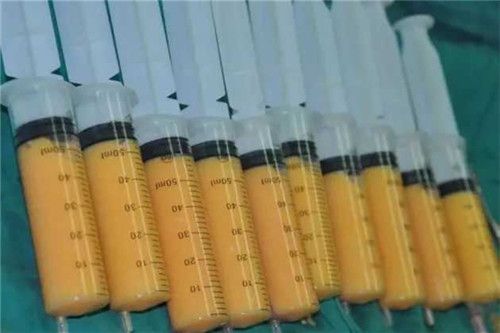 针管吸出的脂肪图