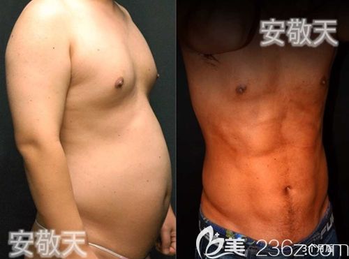 安敬天院长男士5D腹肌吸脂术
