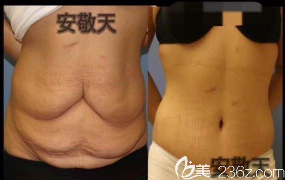 安敬天院长腰腹吸脂解决妊娠纹