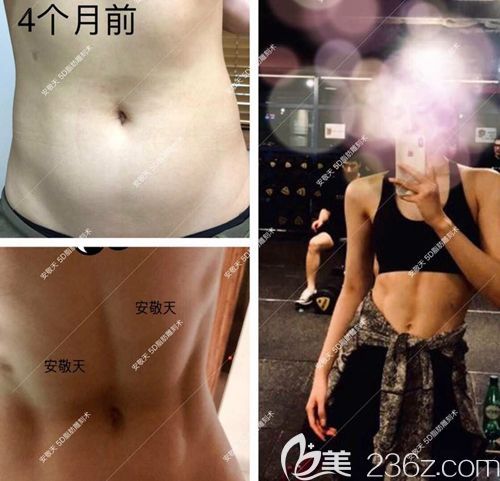 韩国安敬天院长5D腰部马甲现吸脂