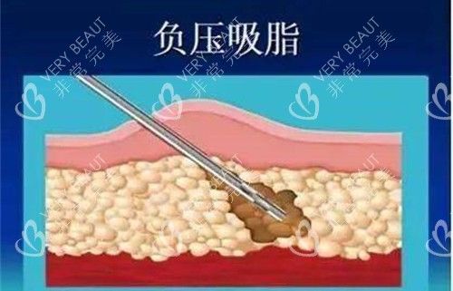 负压吸脂卡通图