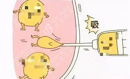 吸脂卡通展示图