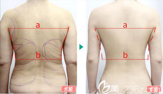 北京纯脂冯斌医生后背吸脂实例