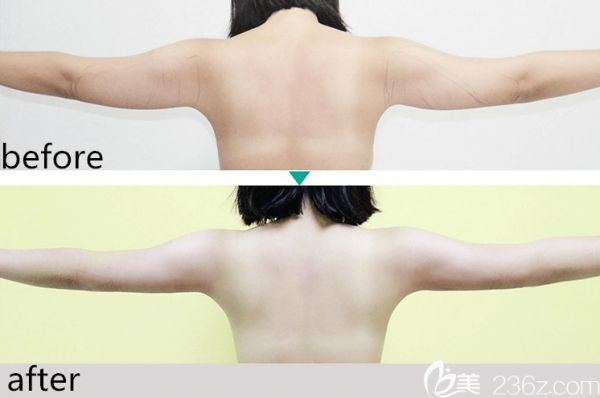 北京纯脂冯斌医生手臂吸脂实例