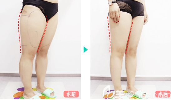 北京纯脂冯斌医生大小腿吸脂实例