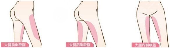 腿部吸脂需要多少钱一般?
