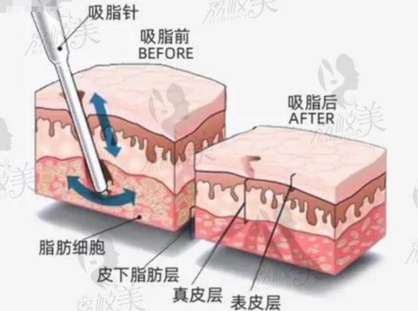 国内吸脂比较有名的医师名单整理