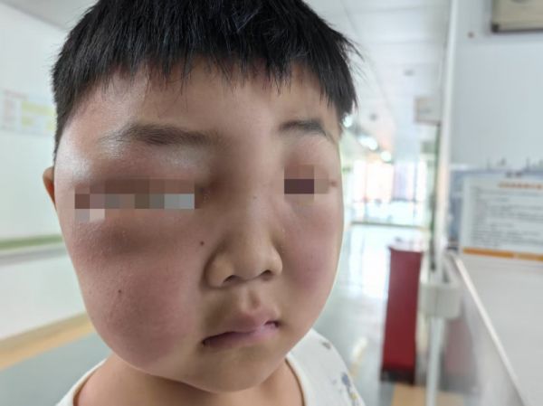 入院时，洋洋的脸又肿又疼。 医院供图