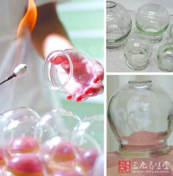拔火罐的误区二：时间越长效果越好