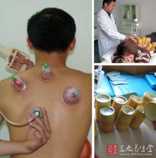 拔罐禁忌及注意事项