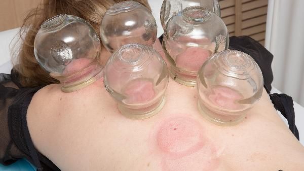 拔罐对运动员的好处