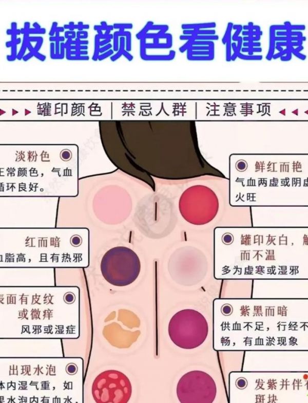 拔罐位置（拔罐位置对照表）
