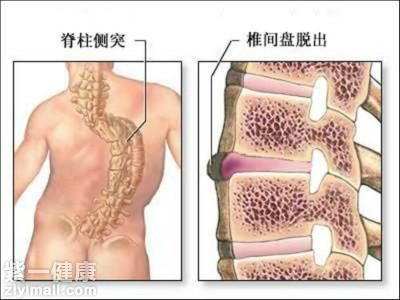 脊柱弯曲的锻炼方法有哪些 推荐2种运动练习方法