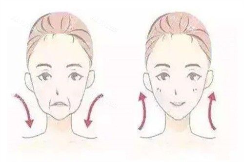 面部V雕对比卡通示意图