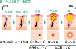 ニキビの種類・重症度