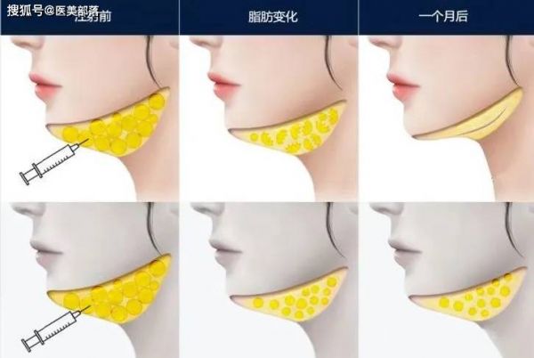 科笛集团 | 旗下「双下巴」溶脂针「CU-20401」完成II期临床试验