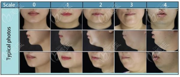 受试者入选标准包括年龄在18至65岁之间成年人,医生报告的颏下脂肪评分量表评估为2级或3级的中度至重度颏下脂肪堆积