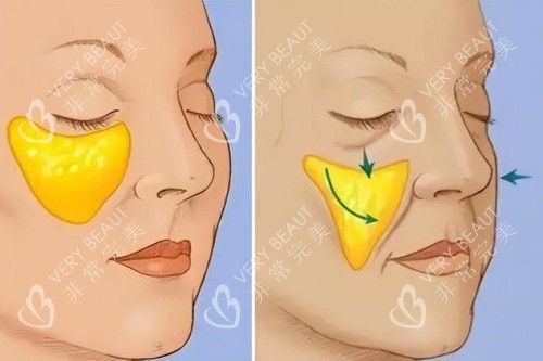 苹果肌下垂于正常苹果肌卡通对比图